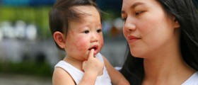 Atopic Dermatitis and Babies: Should You Treat Eczema in Infants with Medications or Naturally?